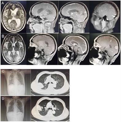 Hepatoid adenocarcinoma of the lung with PD-L1 expression and the response to anti-PD-1 therapy: a case report